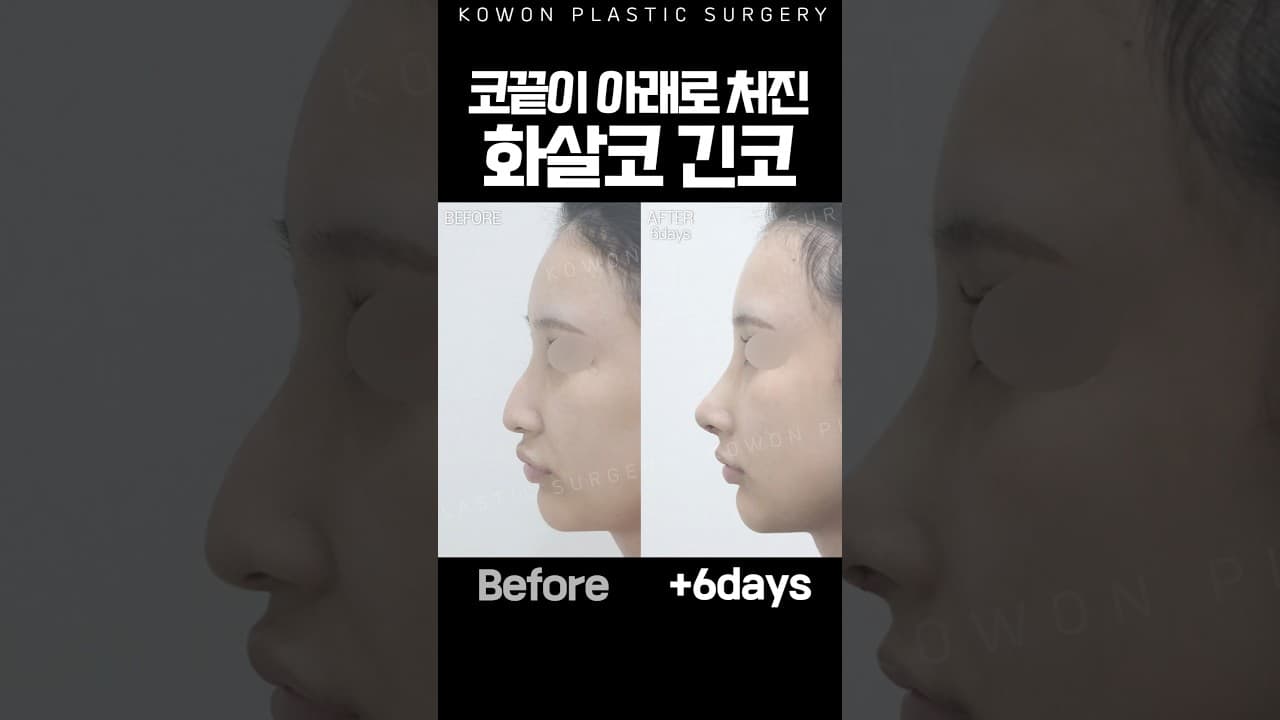 긴코, 화살코, 코끝처짐 고민? 자려한변화! (코끝근육교정) #shorts #kbeauty #코원성형외과
