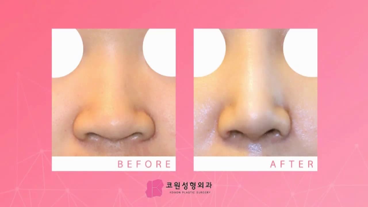 코원성형외과의 코성형 전후사진을 영상으로 한눈에 보여드립니다.
