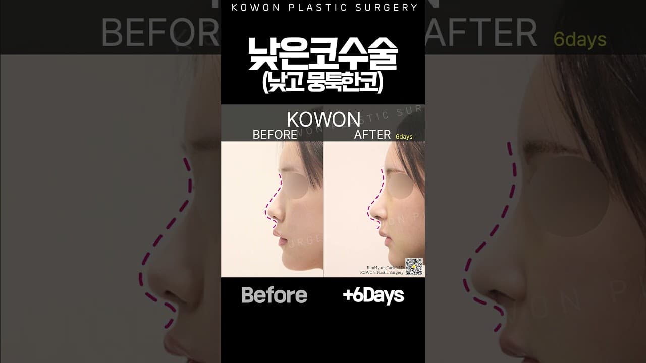 낮은코 자연스럽게 높였더니?