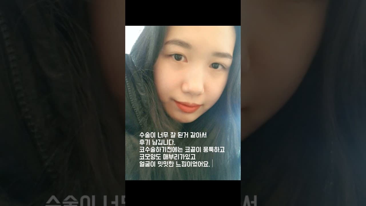 코원성형외과 리얼후기 | 매부리코교정+지방이식귀여운이미지에서 세련된이미지로