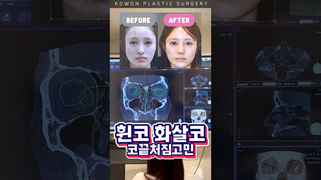 휜코 화살코 수술했더니?
