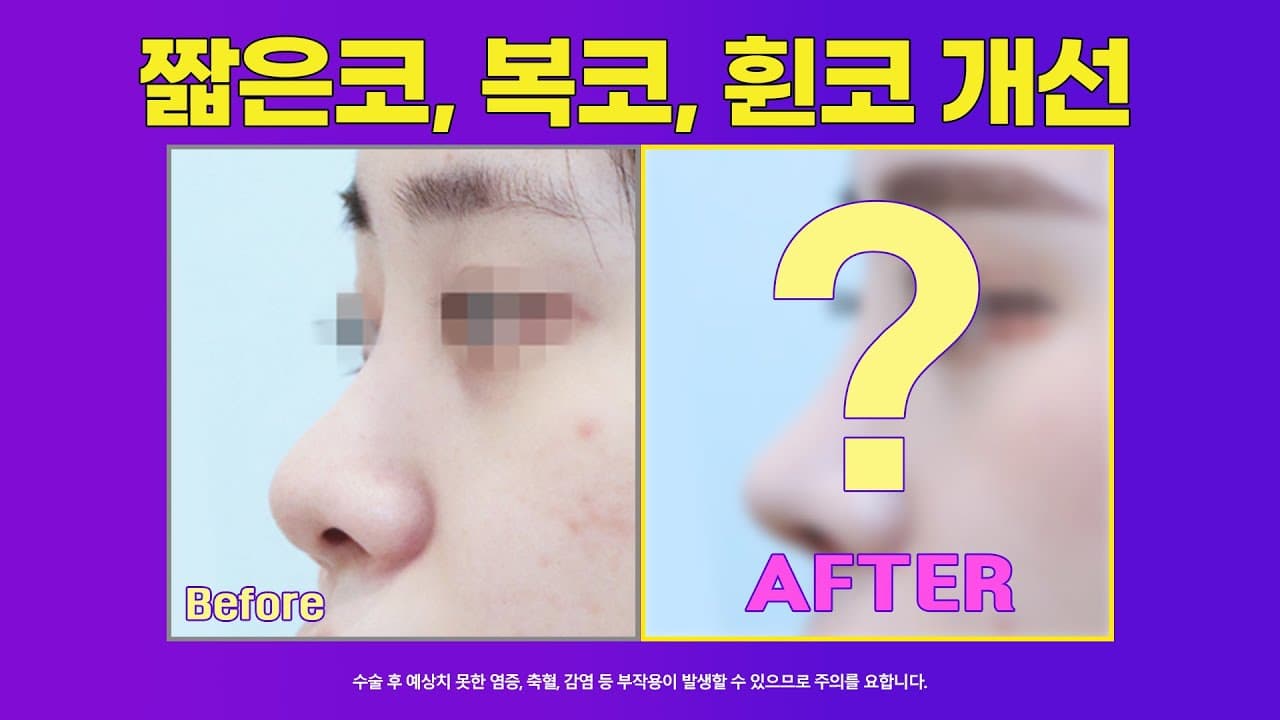여자 복코 전후 : 짧은코, 복코, 휜코느낌개선 비중격연장 2주차 수술 전 후 (feat. 필러녹이기)#nosejob #だんご鼻