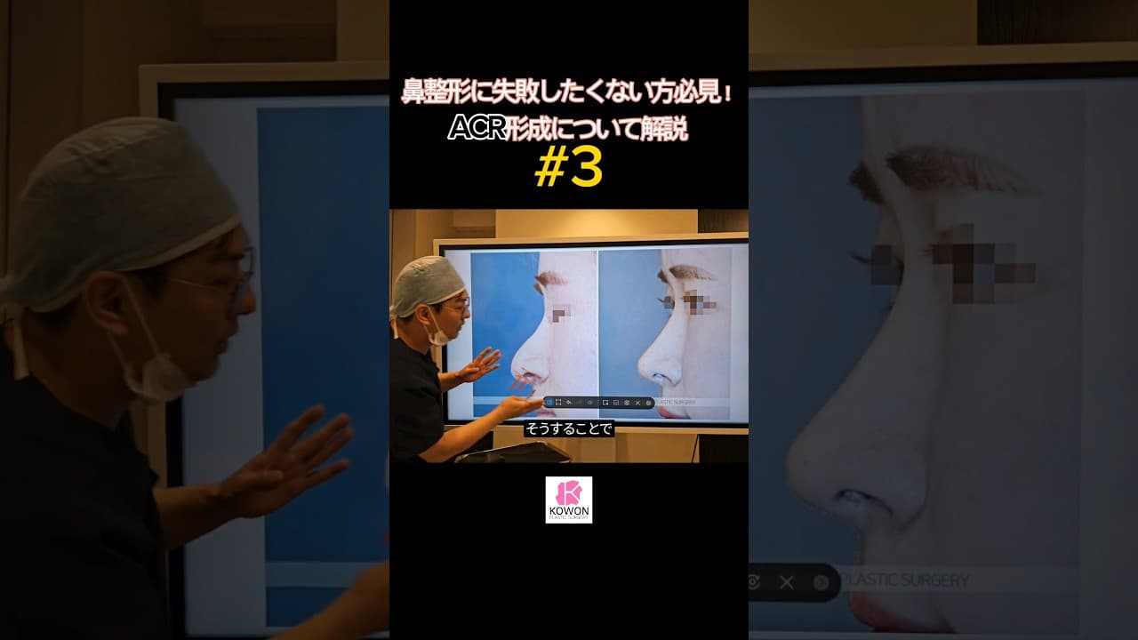 Part.3 鼻整形に失敗したくない方必見！鼻整形の仕上がりを左右するACR形成について解説