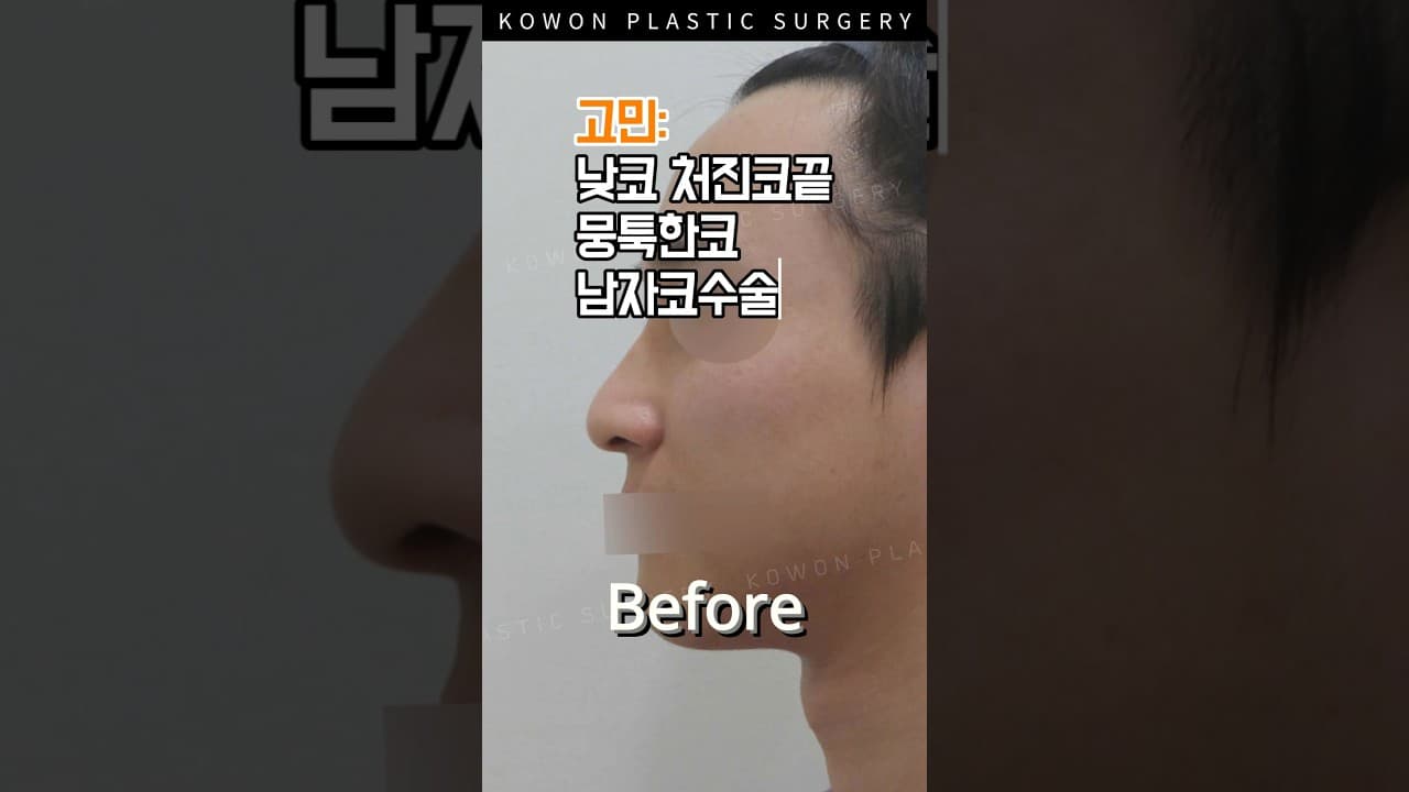 남자코 처진 코끝까지 정리했더니? #코원성형외과 #코원 #kowon #KOWON PLASTIC SURGERY #남자코수술 #남자코성형후기
