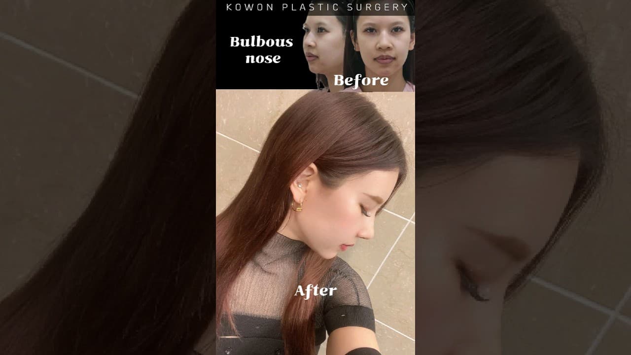 복코 코끝 콧볼 작게 줄이고 예뻐짐 교정전~한달차까지 같이 보기
