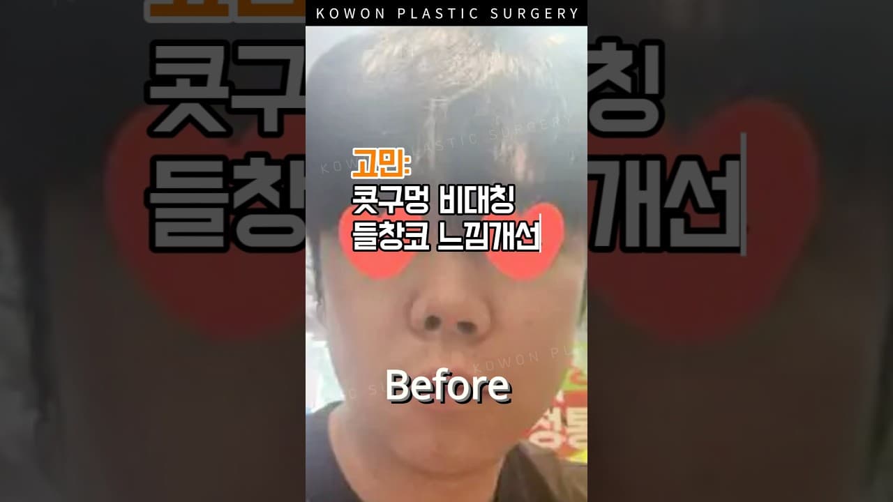 남자 짧은코, 들창코 입매까지 바뀜