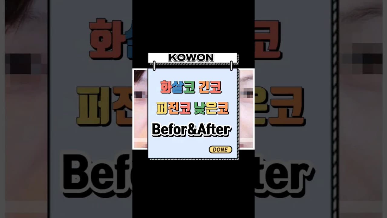 [KOWON] 화살코 긴코 퍼진코 낮은코 수술 전 후 (Nose Job Before&After)