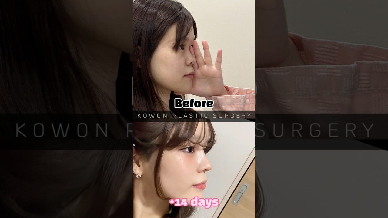 코원 낮은코 교정 후 귀여운 이미지에서 여성스럽게 🥰