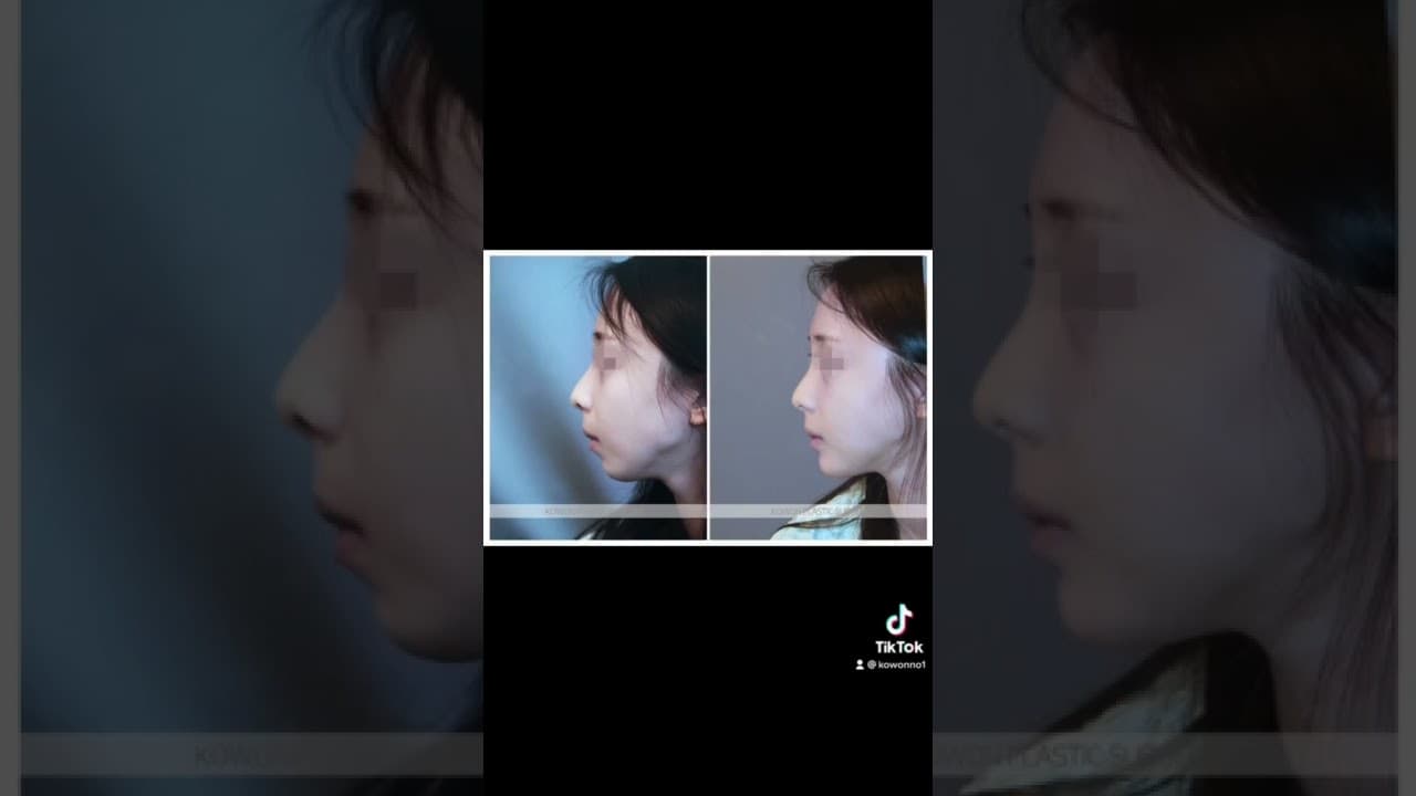 코원성형외과 코 성형 ★Before & After★