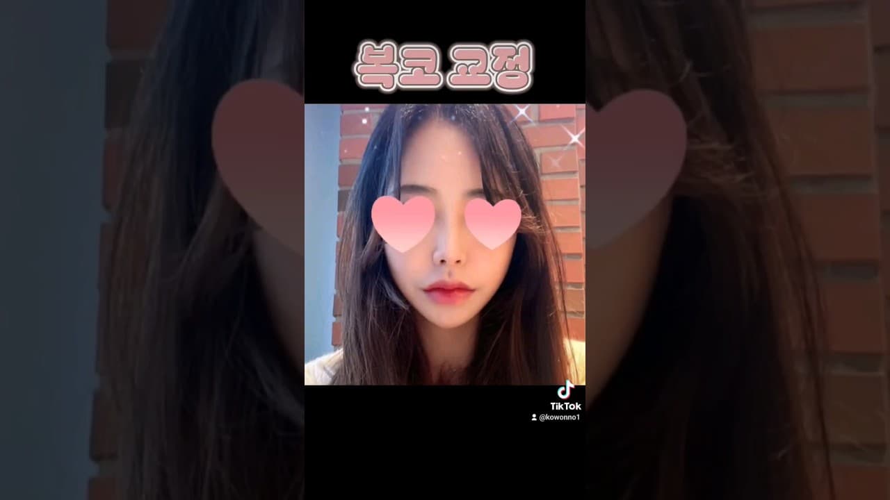 코원성형외과 복코교정수술후기