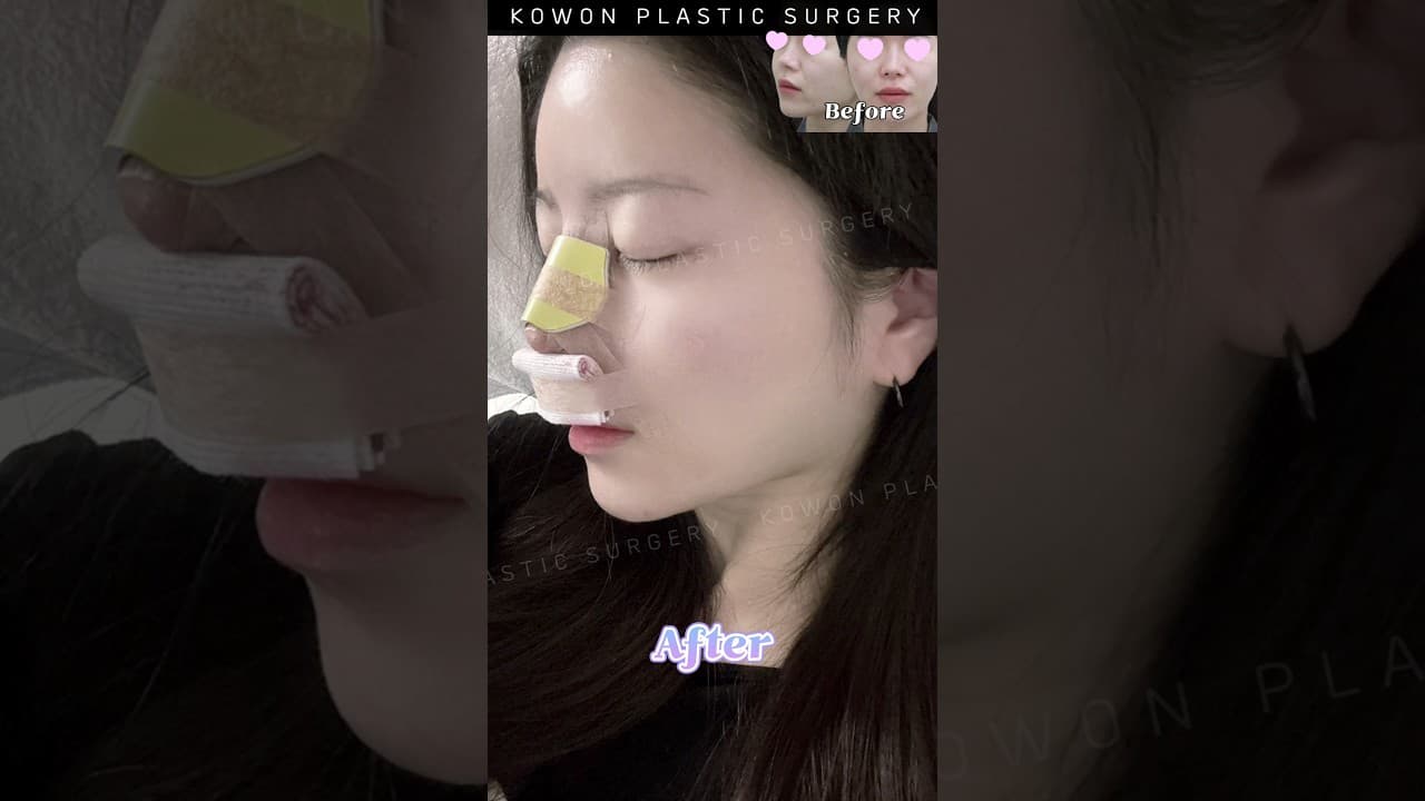타원 코수술 후 코끝 올라가는 증상으로 코원에서 코재수술