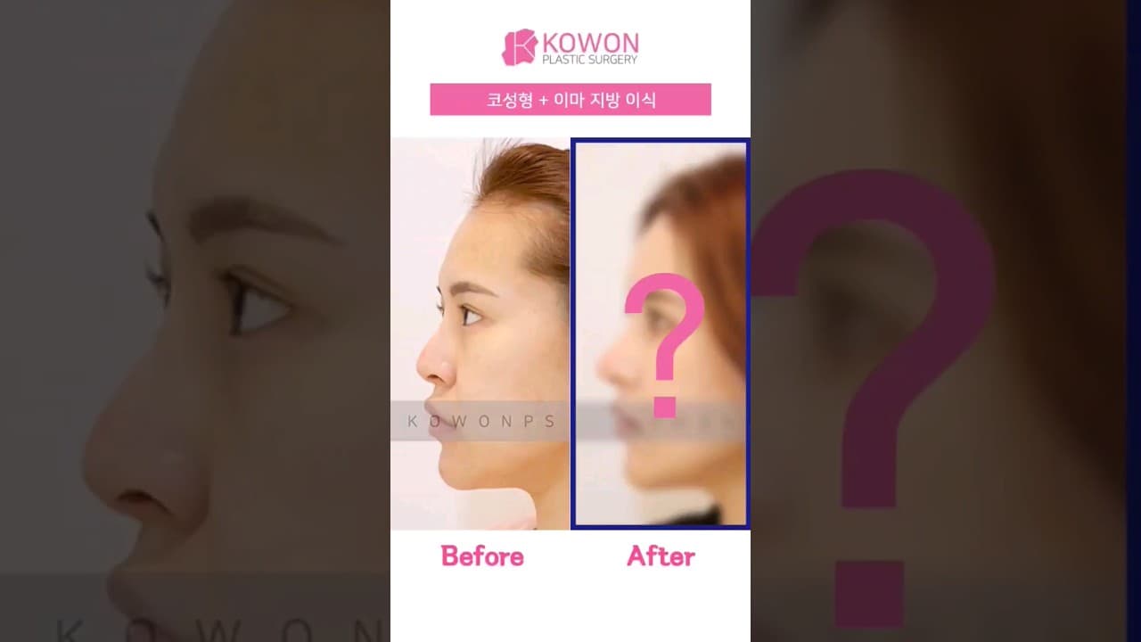 코성형후기| 코와 지방 이식을 동시에! 여성스럽고 입체감있는 얼굴완성!