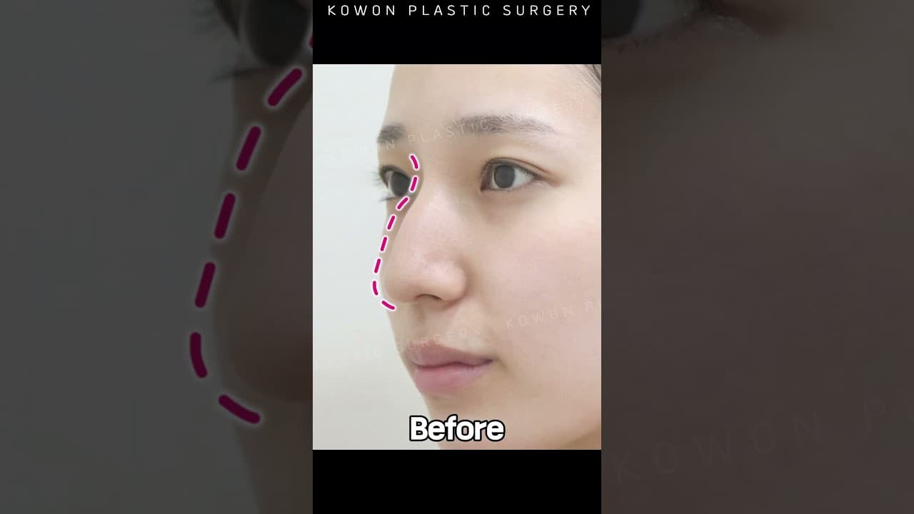 콤플렉스였던 매부리코, 교정 후 대변신!