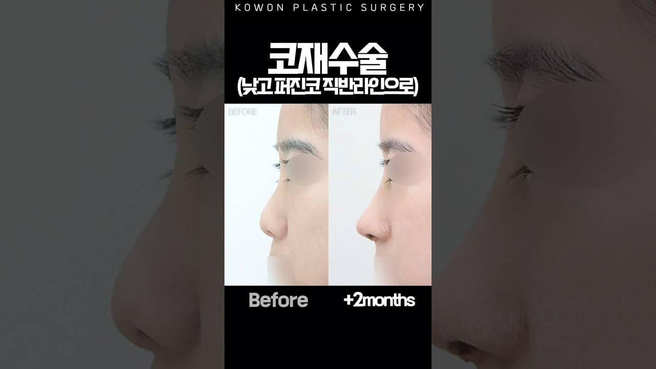 코수술했지만 퍼지고 처진 코끝, 비대칭 콧구멍 고민이었어요. 코원에서 직반라인으로 코 재수술 #nosejob #코원성형외과