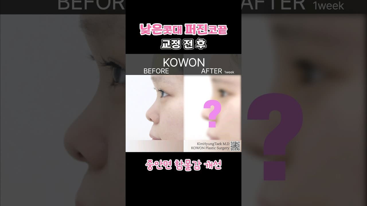 낮은콧대 퍼진코 교정으로 중안면부 함몰감 개선