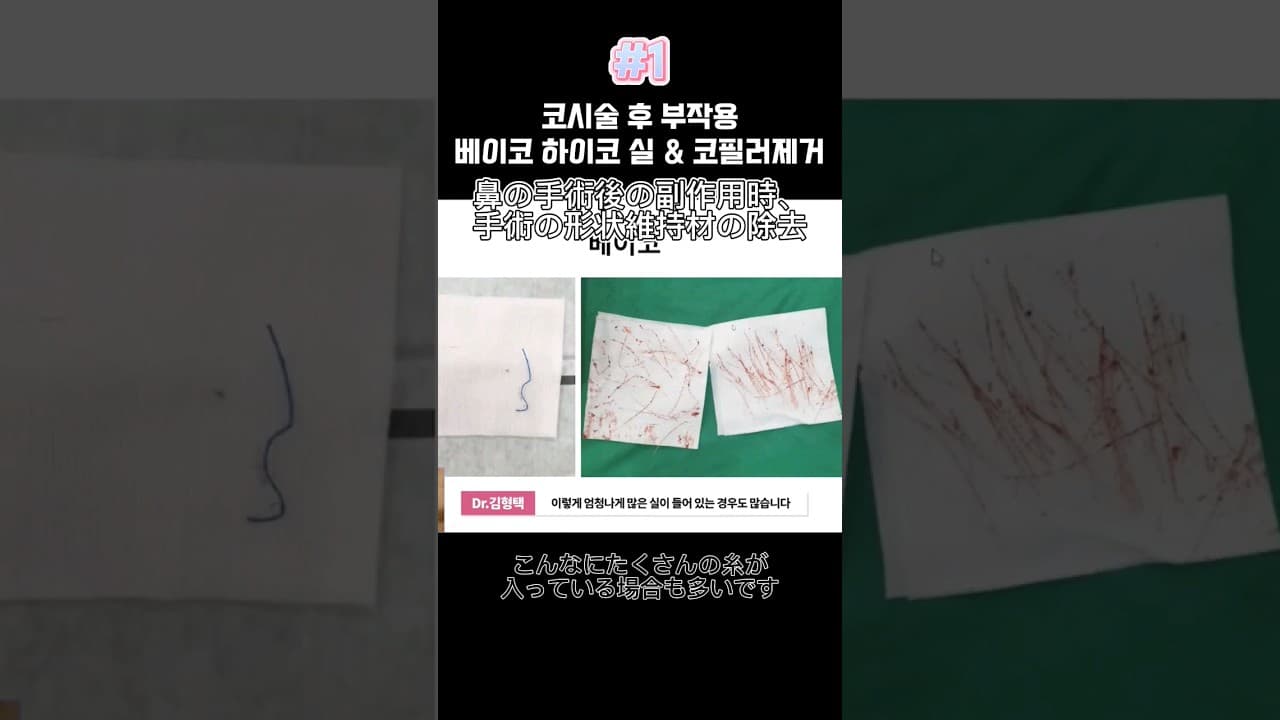 코시술 부작용베이코 하이코 실&코필러제거 1편(鼻の手術後の副作用時、手術の形状維持材の除去 Part.1)