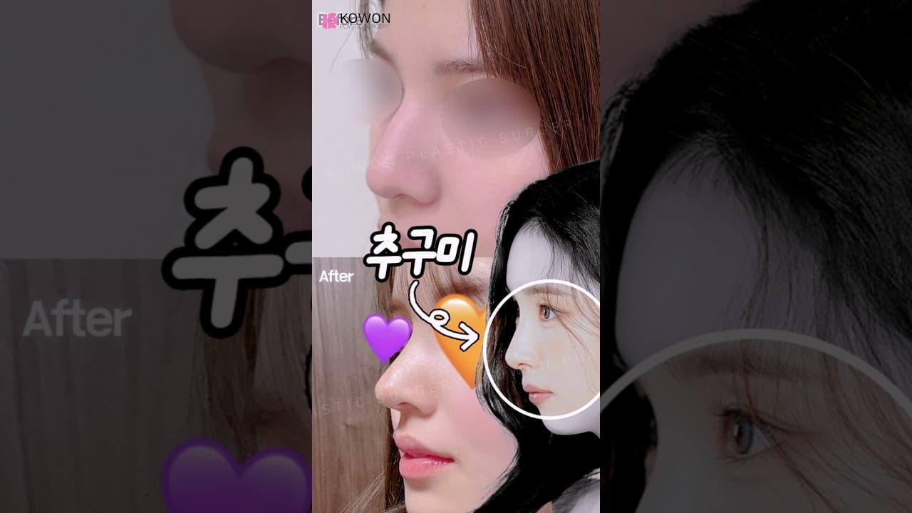 신세경 코 라인이 추구미라면?! 매부리 교정과 미간 꺼짐이 부드럽게 개선된 직반버선 라인 비포에프터 👃✨