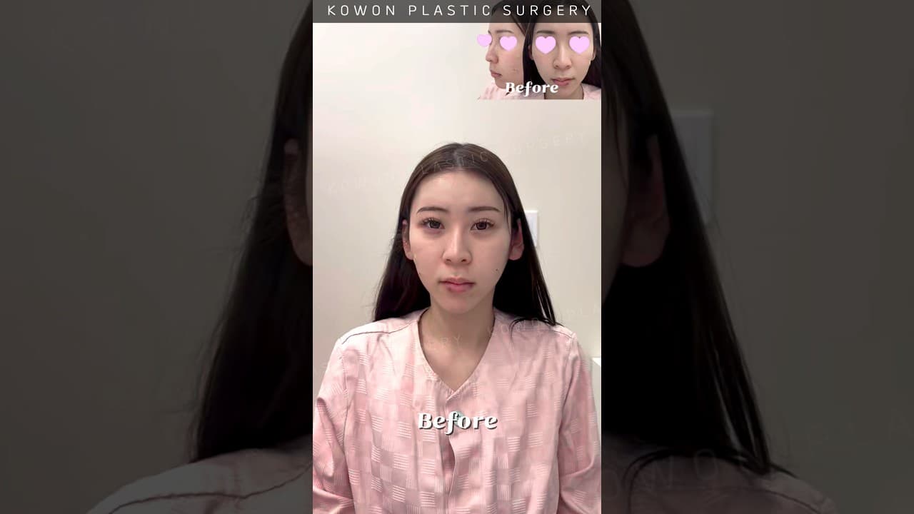 매부리코 휜코 고민이였어요