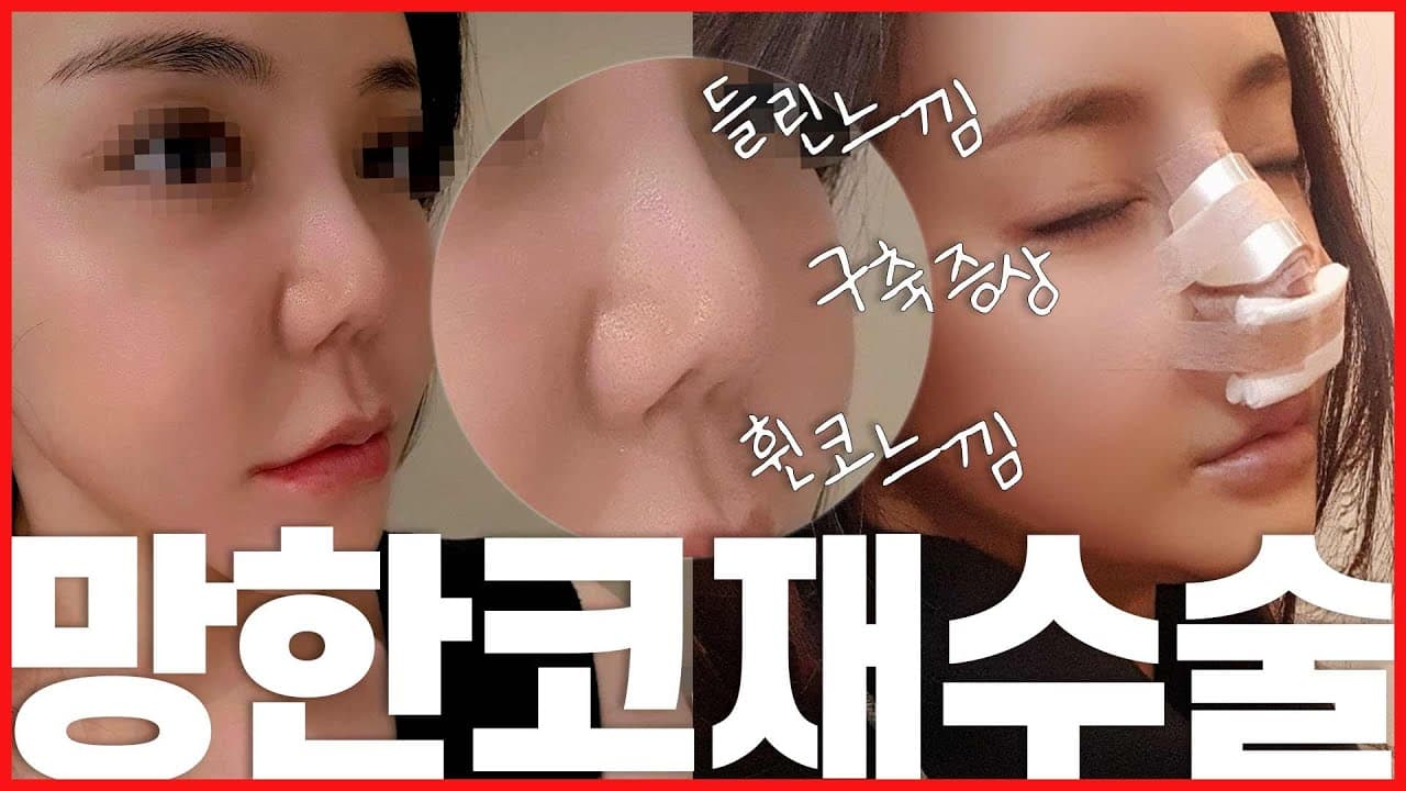 코재수술 Vlog 수술전~2주차 까지 솔직 후기
