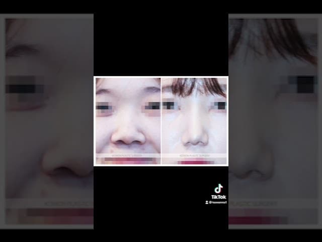 코원성형외과 코 성형 ★Before & After★_매부리코