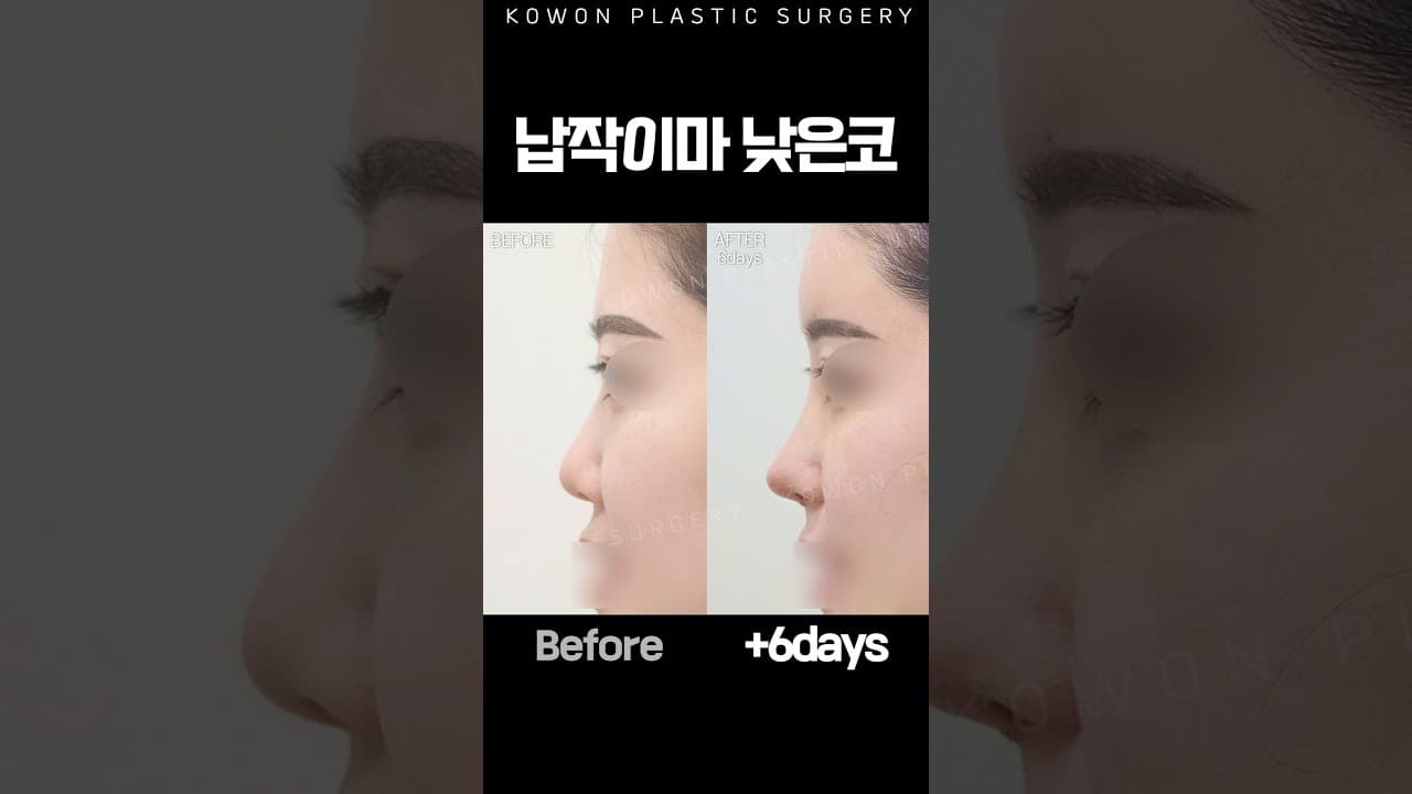 납작한이마 낮은코 돌출입매 개선 (이마지방이식+낮은코수술) #shorts #nosejob