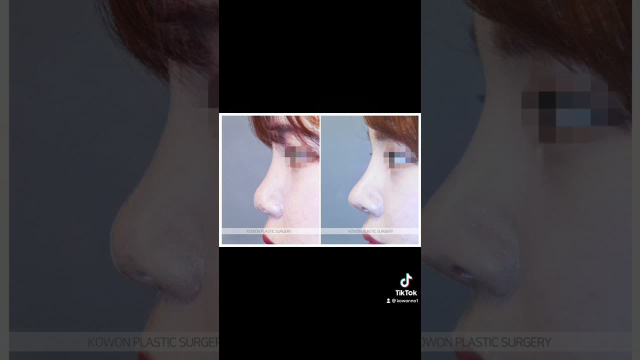 코원성형외과 코 성형 ★Before & After★_복코