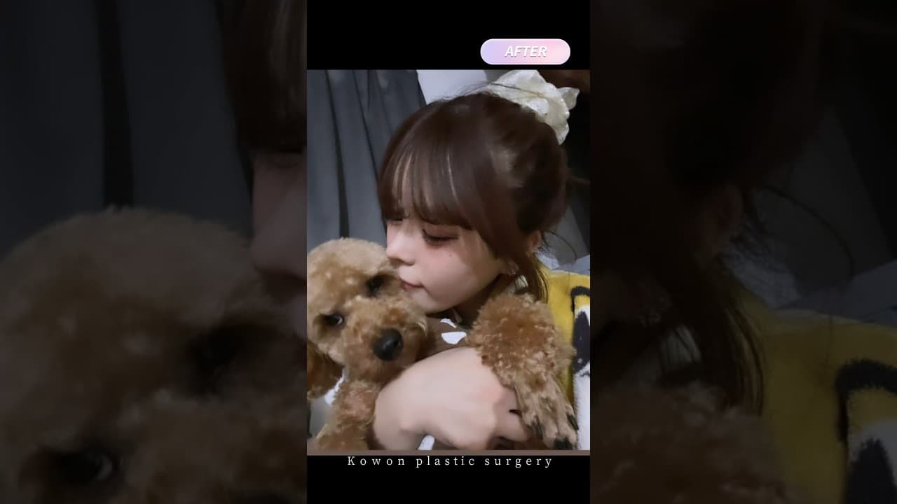 납작코, 낮은 콧대 자연스러운 교정 증례 , 코원 예쁜 E라인 개선