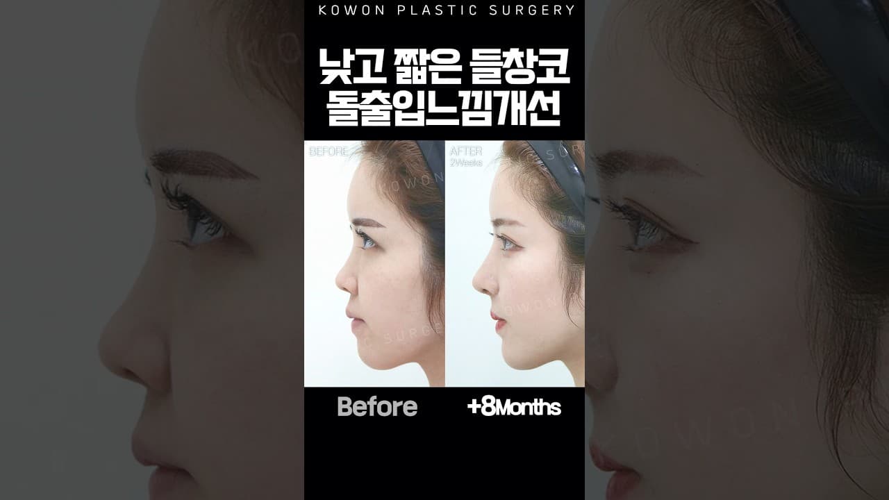 낮고 짧은 들창코, 돌출입 느낌까지 개선가능?