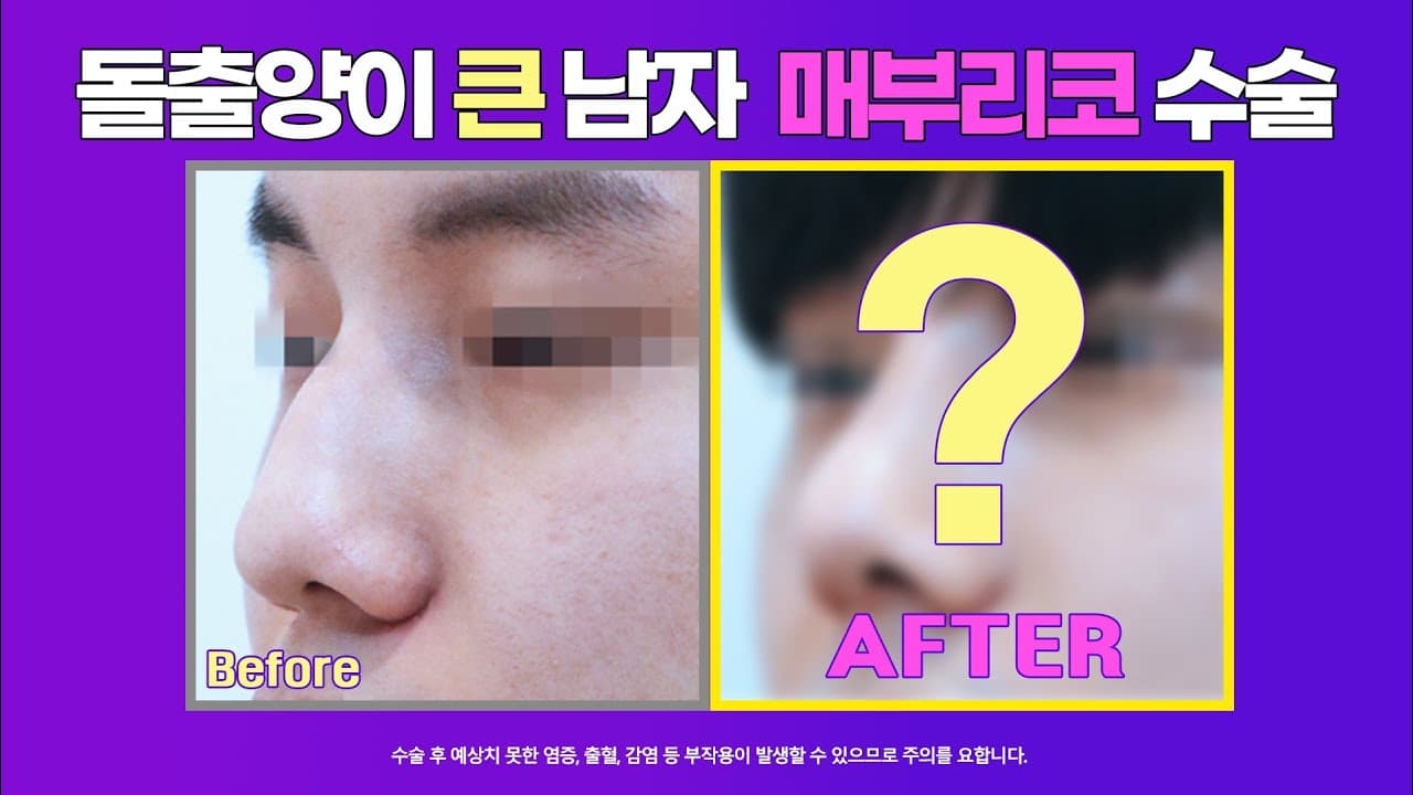 남자 매부리코 수술전후사진 : 비중격만곡증, 매부리코 심한 경우 매부리코절골술로 해결