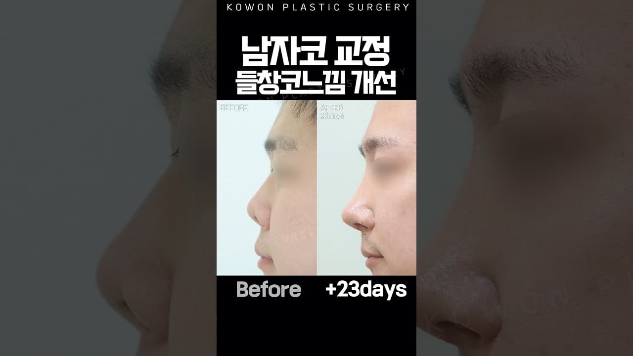 남자코 비대칭 들창코느낌 교정 전 후