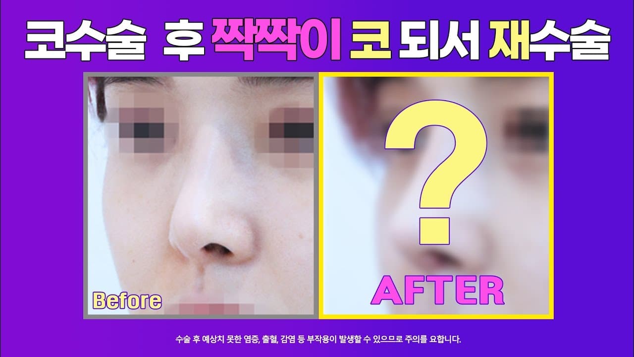 짝짝이코 코재수술 전후사진 : 직선코를 화려한 느낌의 직반버선으로 재수술한 경우