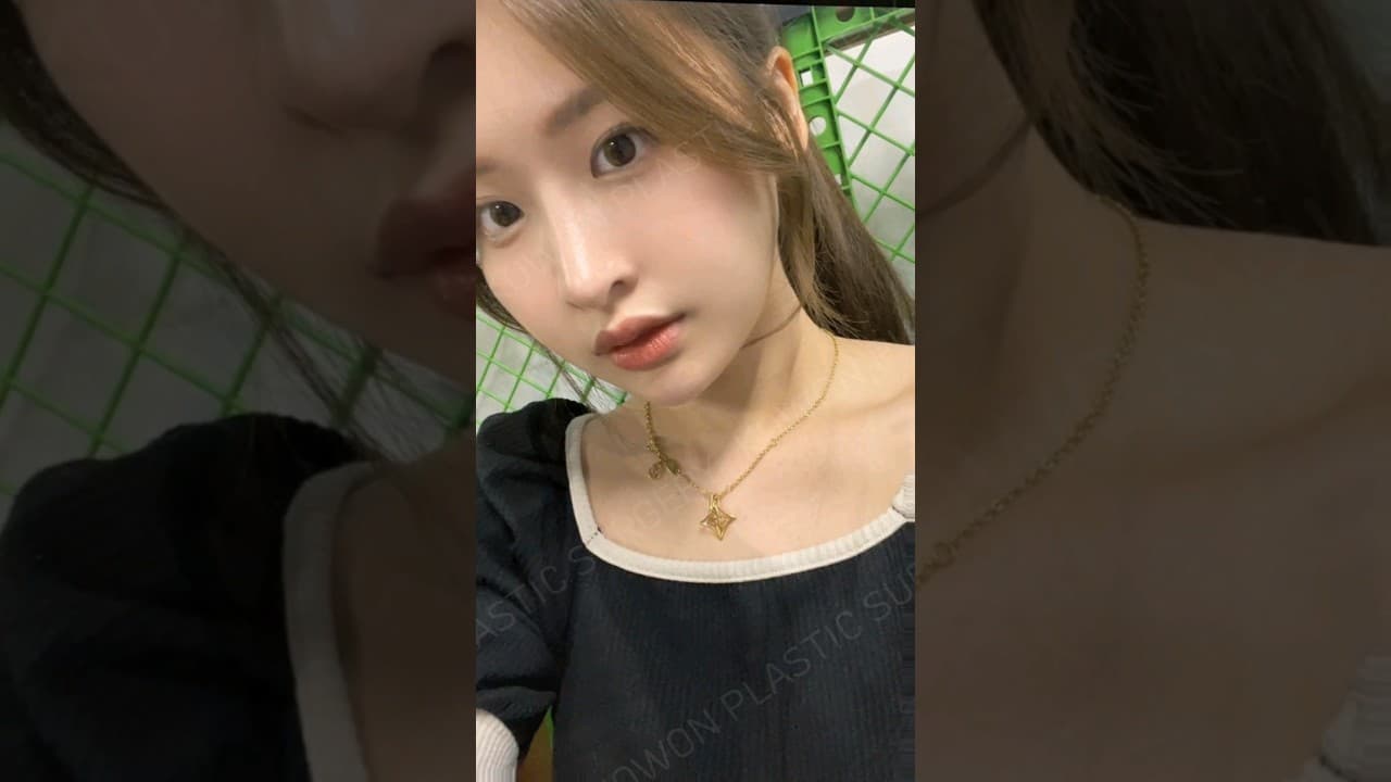 코원 낮은코 교정 증례 모아보기