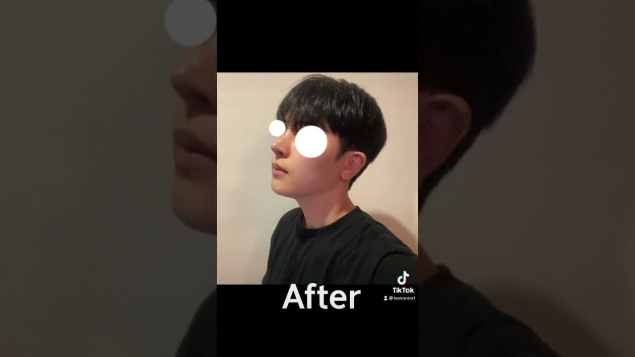 코원성형외과 코 성형 ★Before & After★