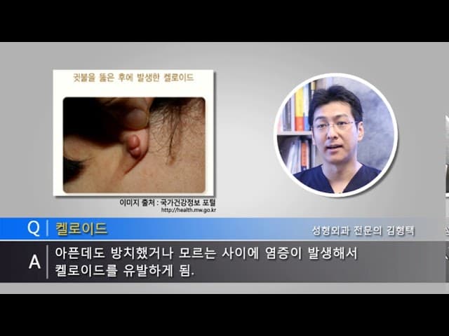 귀켈로이드가 생기는 이유와 제거방법