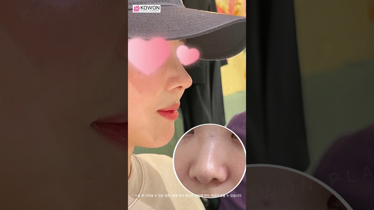 필러 맞은 코, 재수술 가능할까?