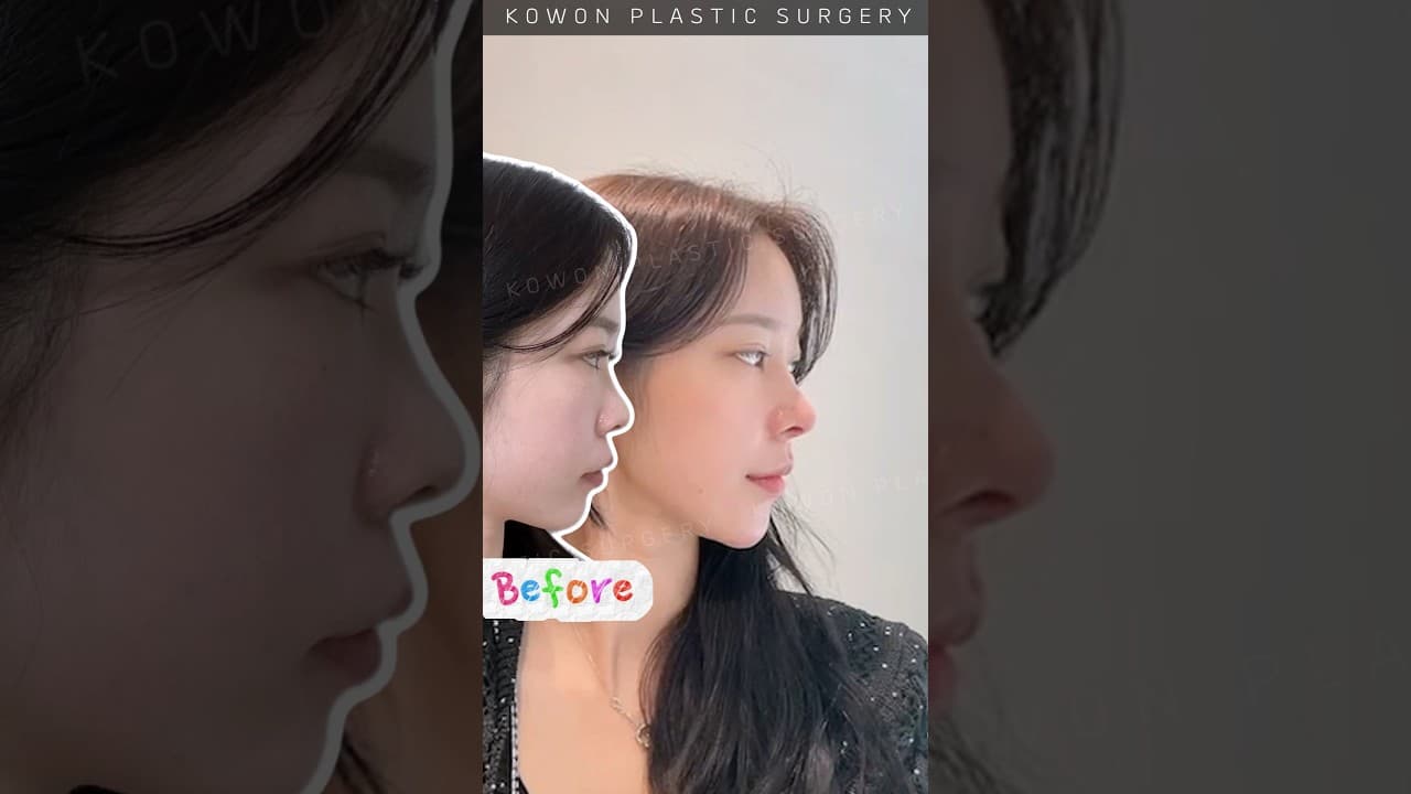 낮은코 화려한 라인으로 코수술하면?
