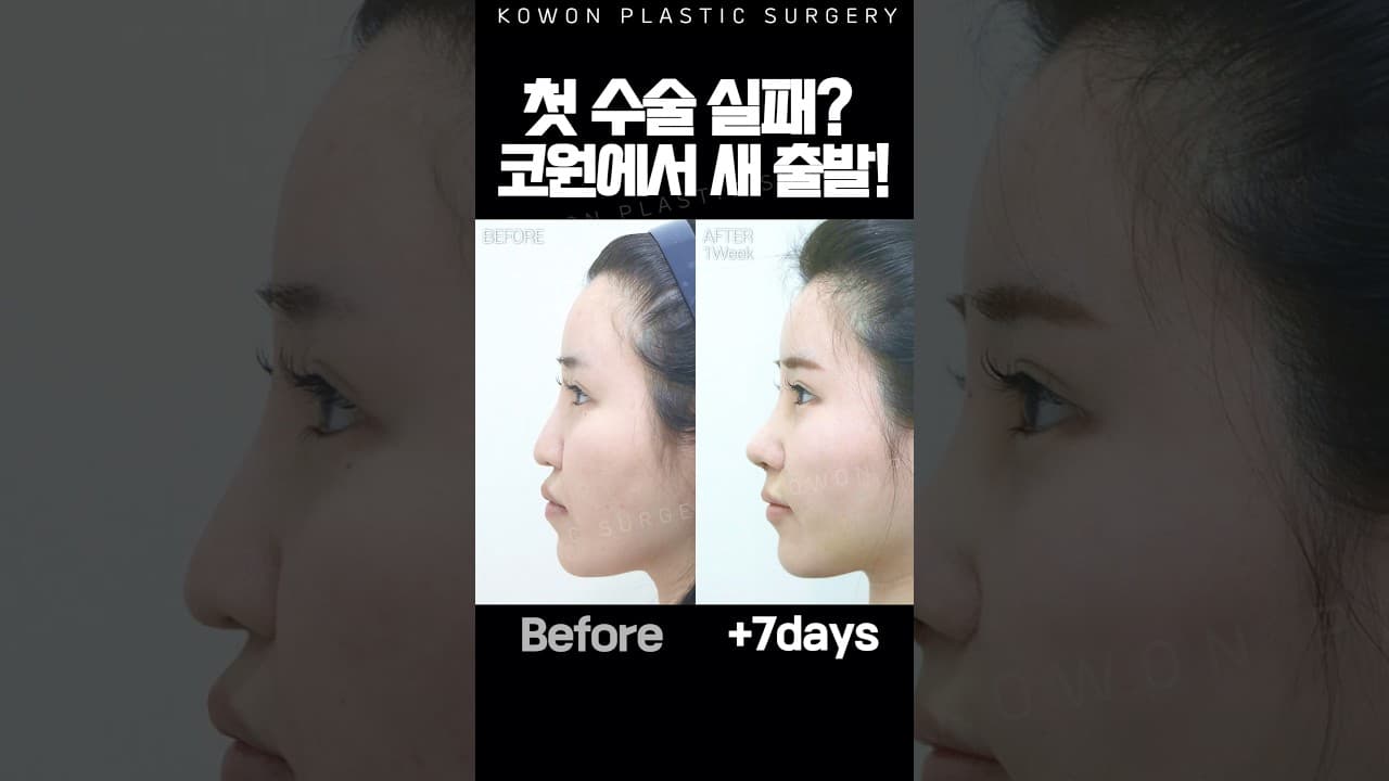 타원 코수술 후 점점 떨어지는 코끝때문에 코원에서 자려한라인으로 코재수술!