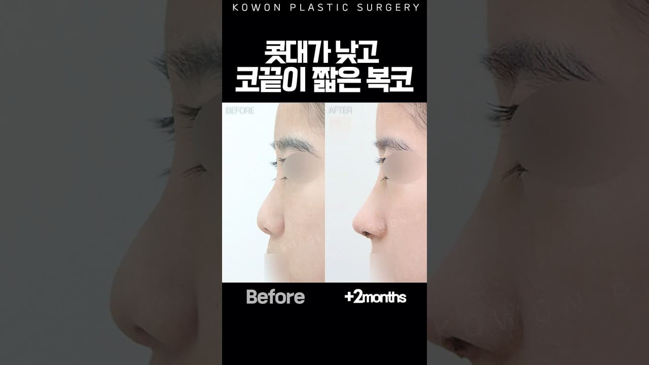 콧대가 낮고 코끝이 짧은 복코