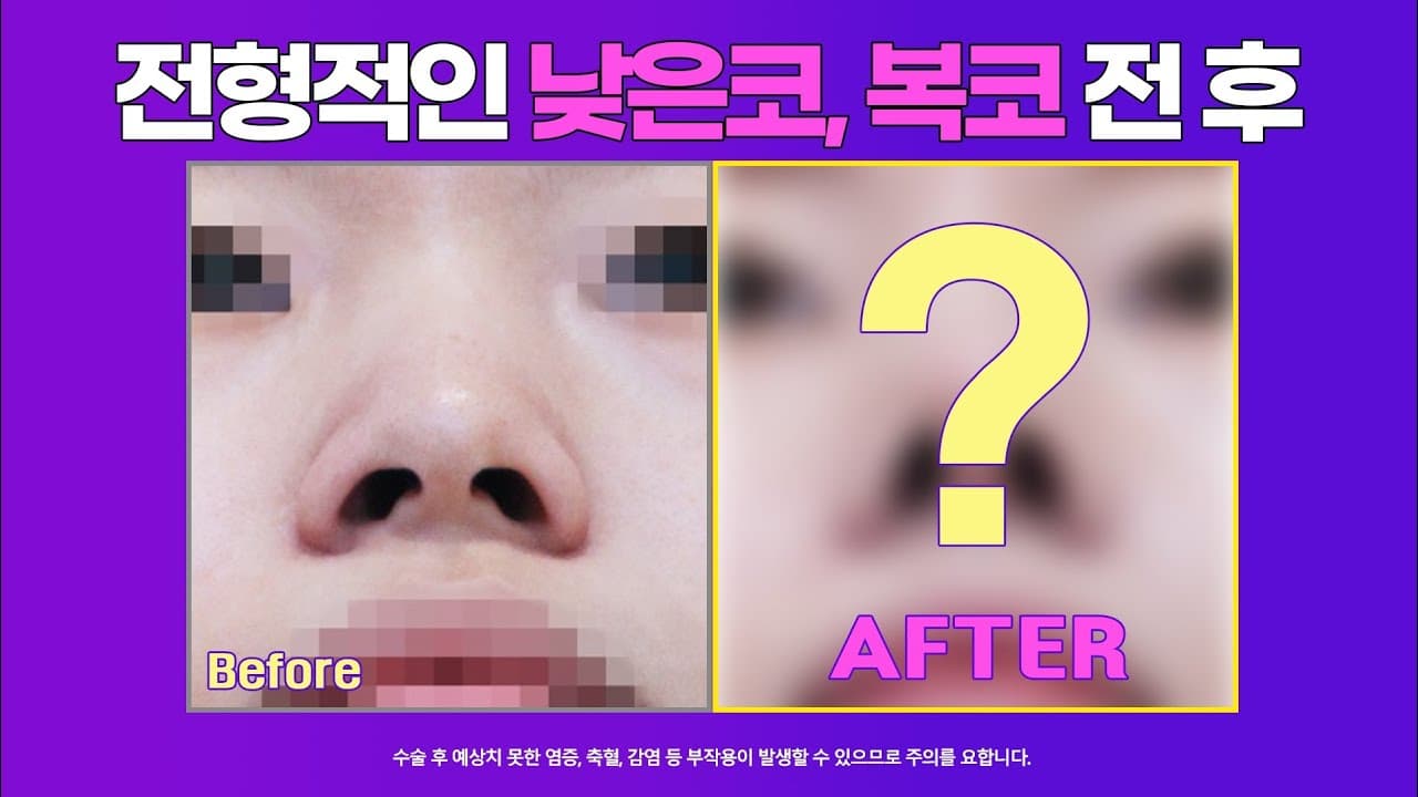 코원 여자 복코, 낮은코수술 전후사진 : 콧등절골술이 필요한 경우