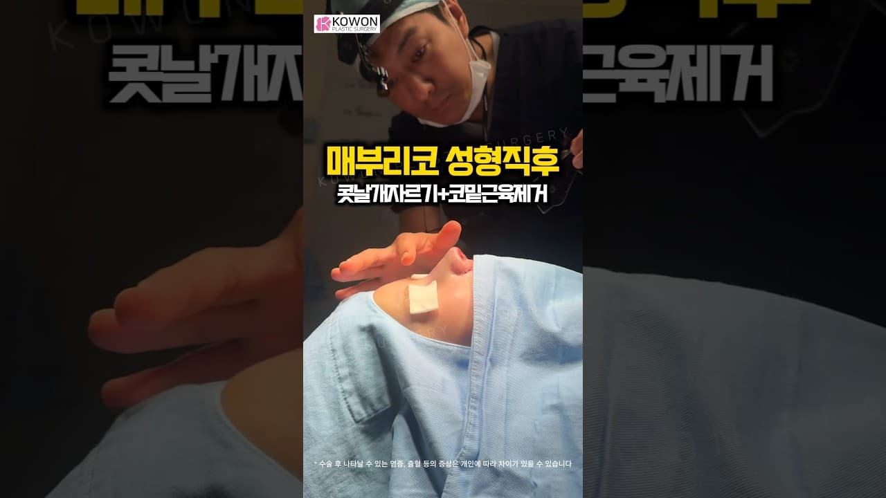 매부리코에 휜 코까지? 콧날개 자르기로 비대칭 잡고 ‘코밑 근육’ 제거로 완성한 인생 코라인 (기증늑 사용)