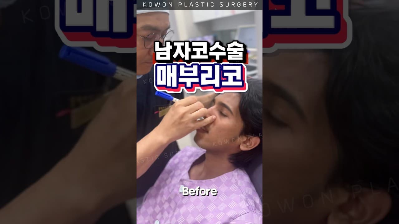 남자 매부리, 이렇게 바뀜? #코원성형외과 #코원 #kowon #KOWON PLASTIC SURGERY #매부리코 #남자코