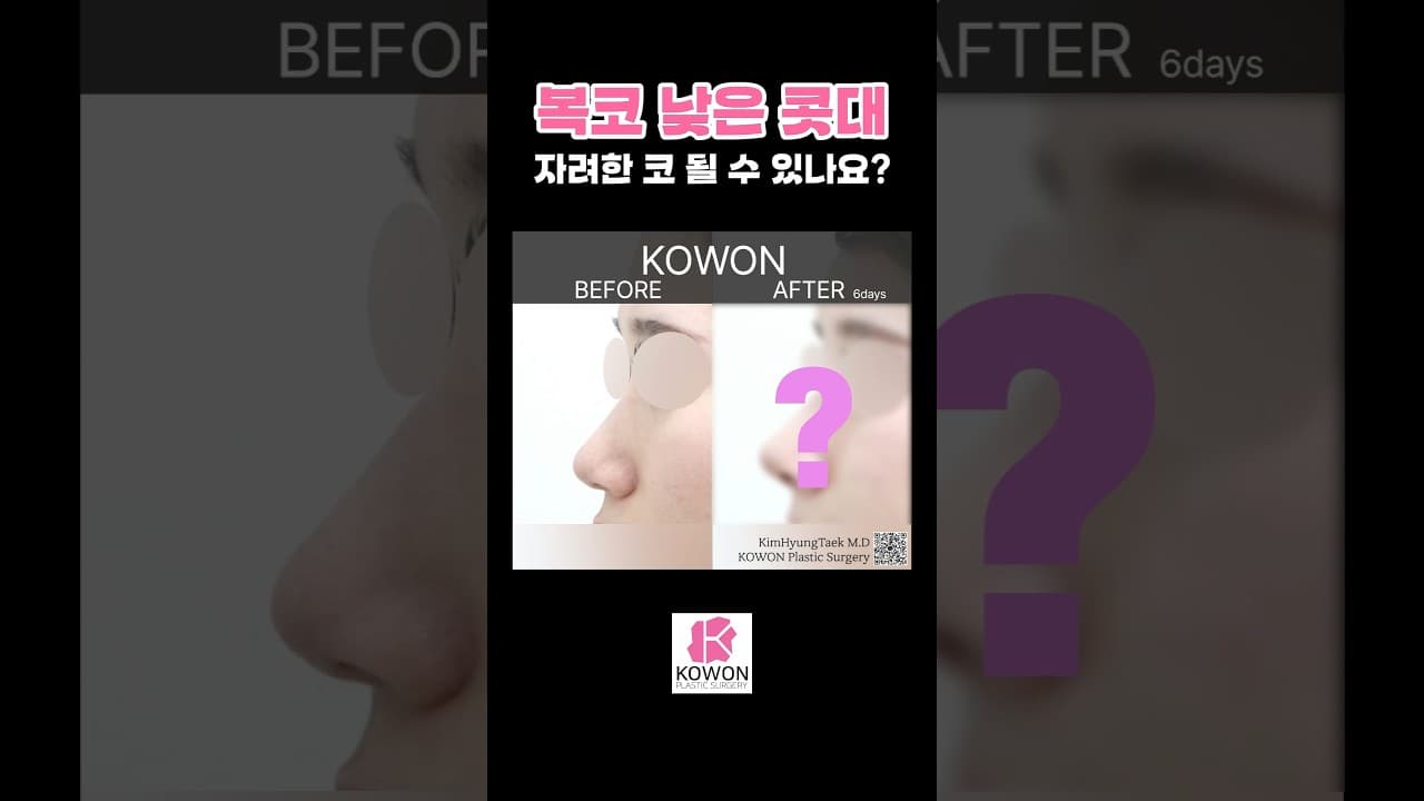복코 낮은 콧대 고민 자려한 코 될 수 있나요?