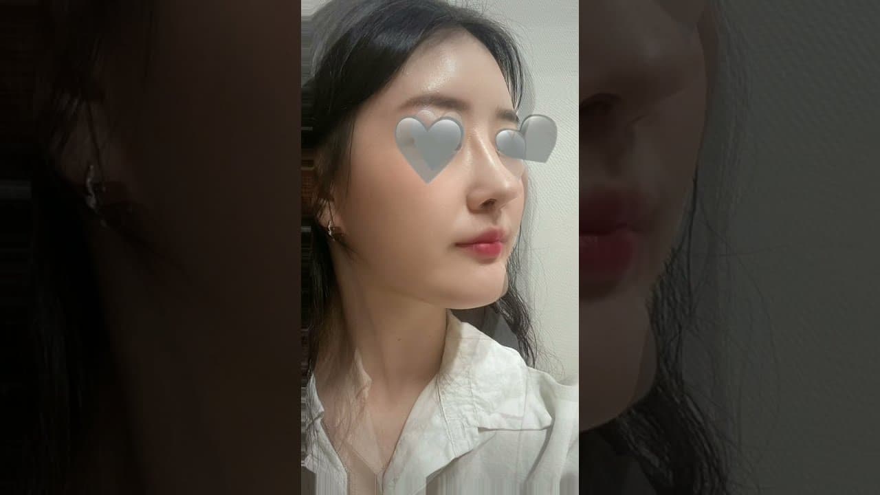 코원성형외과 코 성형 ★Before & After★