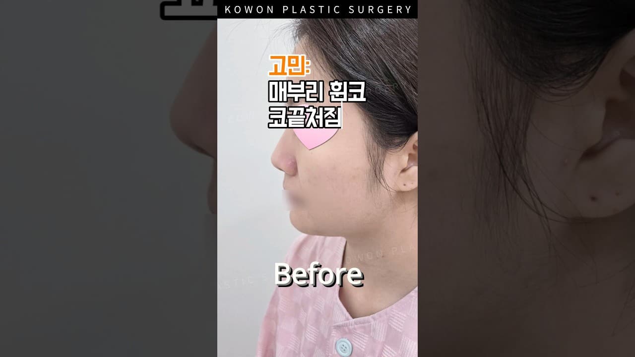 귀여웠는데… 코라인 정리했더니…? (분위기 미쳤다!!) #코원성형외과 #코원 #kowon #KOWON PLASTIC SURGERY #매부리코 #휜코수술