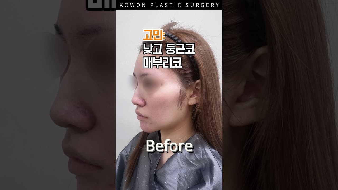낮은코 교정하면서 매부리까지 정리했더니...?