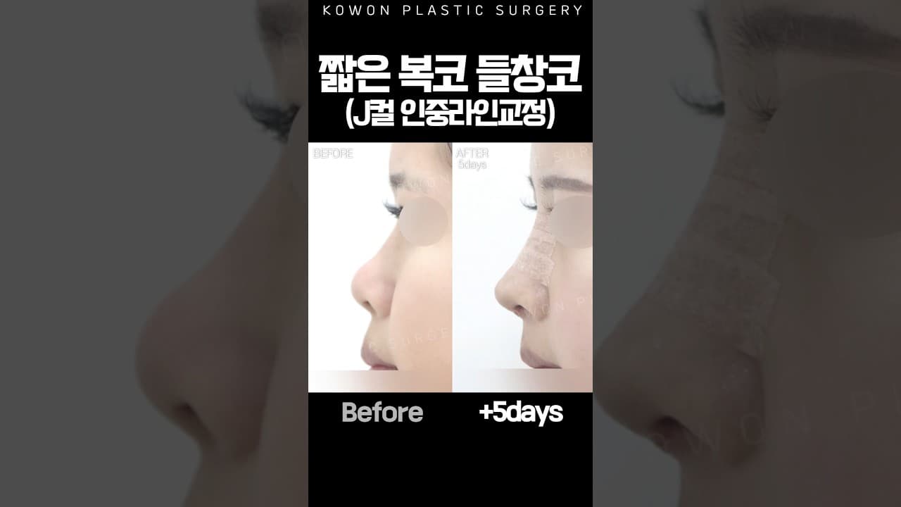 짧은 복코·들창코, J컬 인중라인 교정