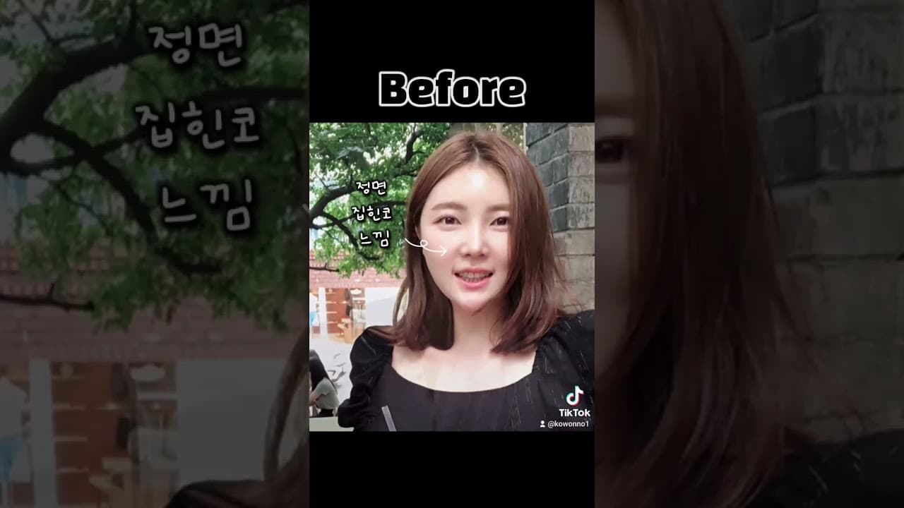들창코느낌을 제압하라! 코성형으로 얻은 완벽한 외모