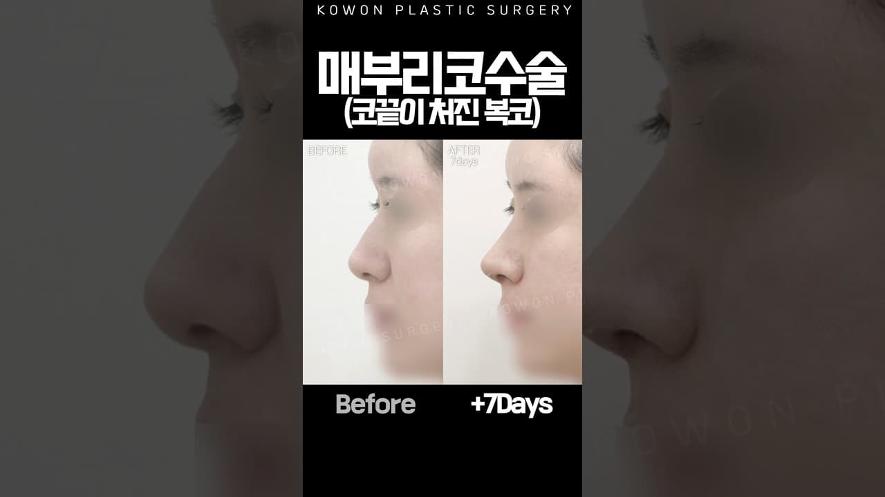 매부리코 코끝이 처진 복코 증례