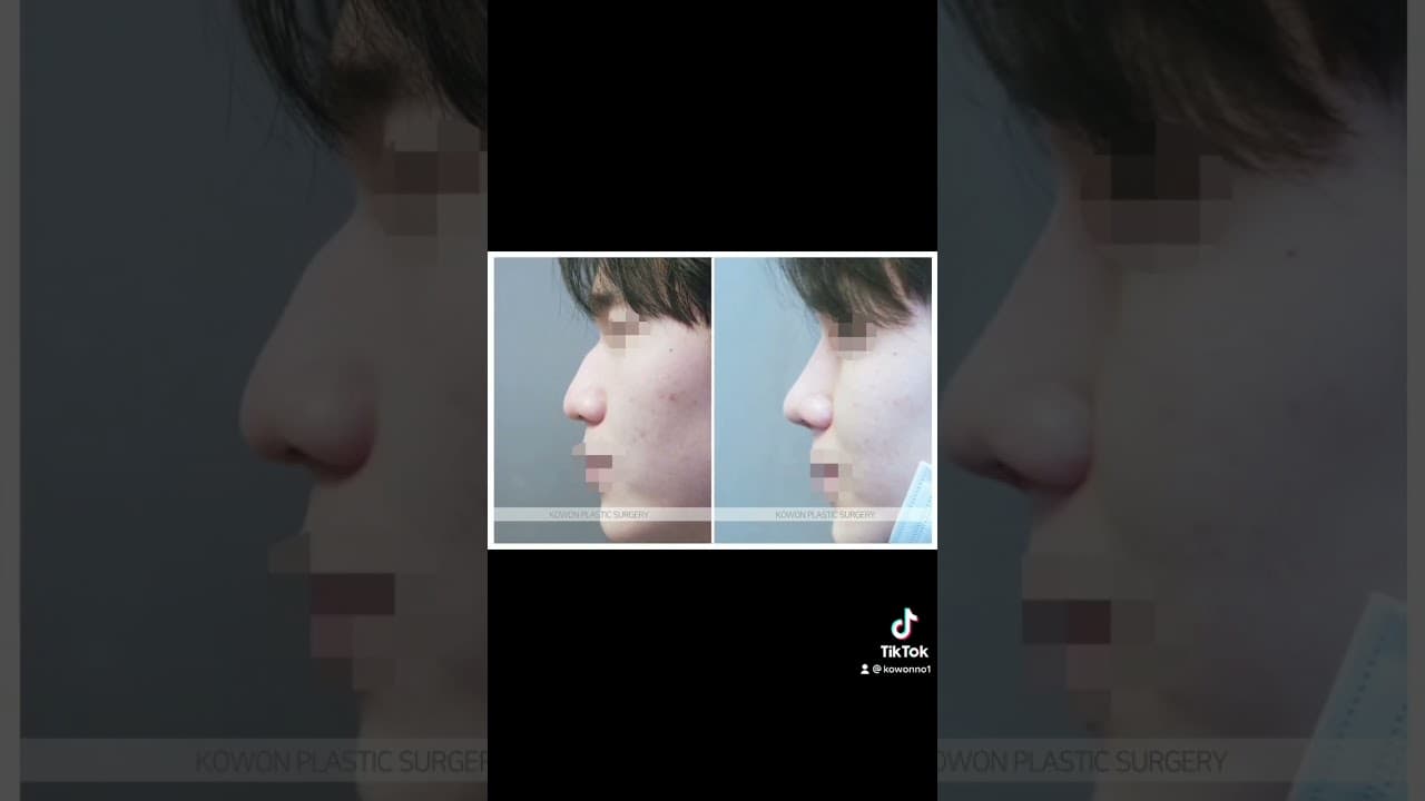 코원성형외과 코 성형 ★Before & After★_남자코