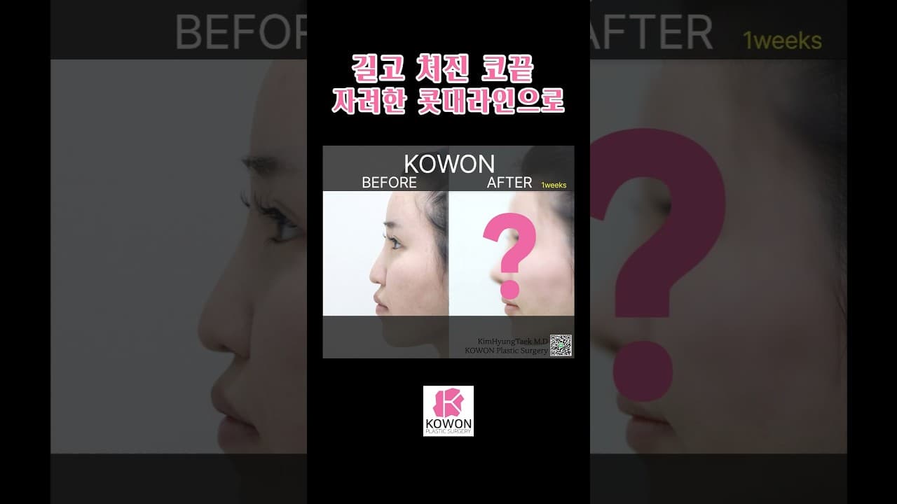 길고 처진 코끝 코원에서 코재수술로 자려한 콧대라인으로